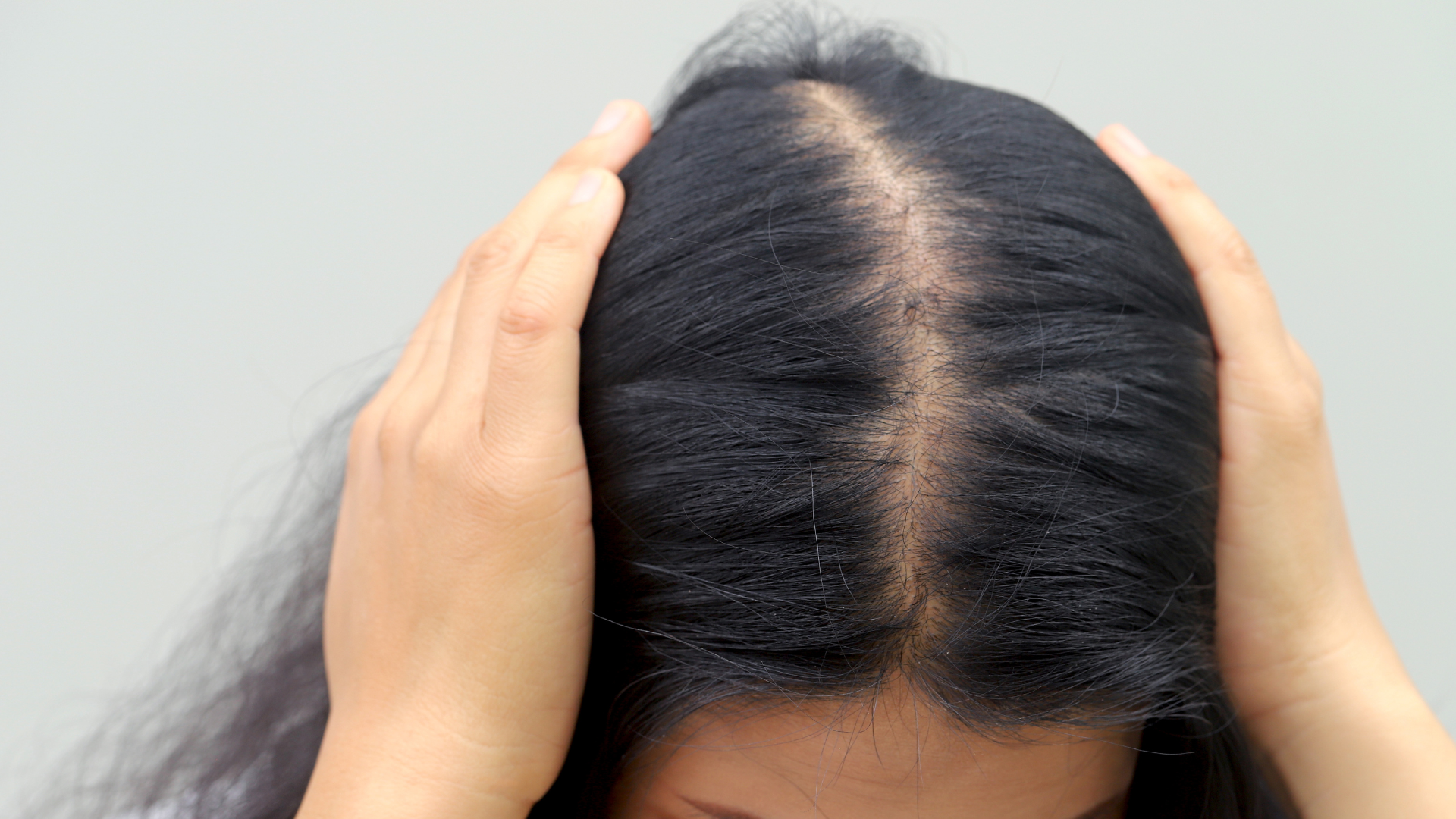 Diffuser Haarausfall bei Frauen – Ursachen & wann eine Haartransplantation sinnvoll ist